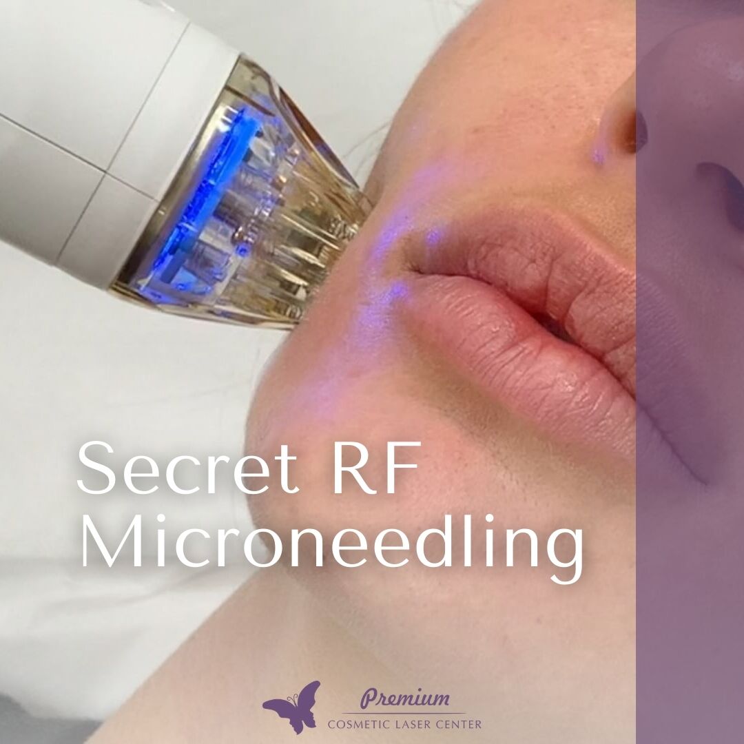Secret RF Microneedling