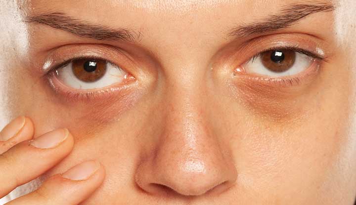 Dark Circles Treatment Dubai | Under Eye Rejuvenation Experts