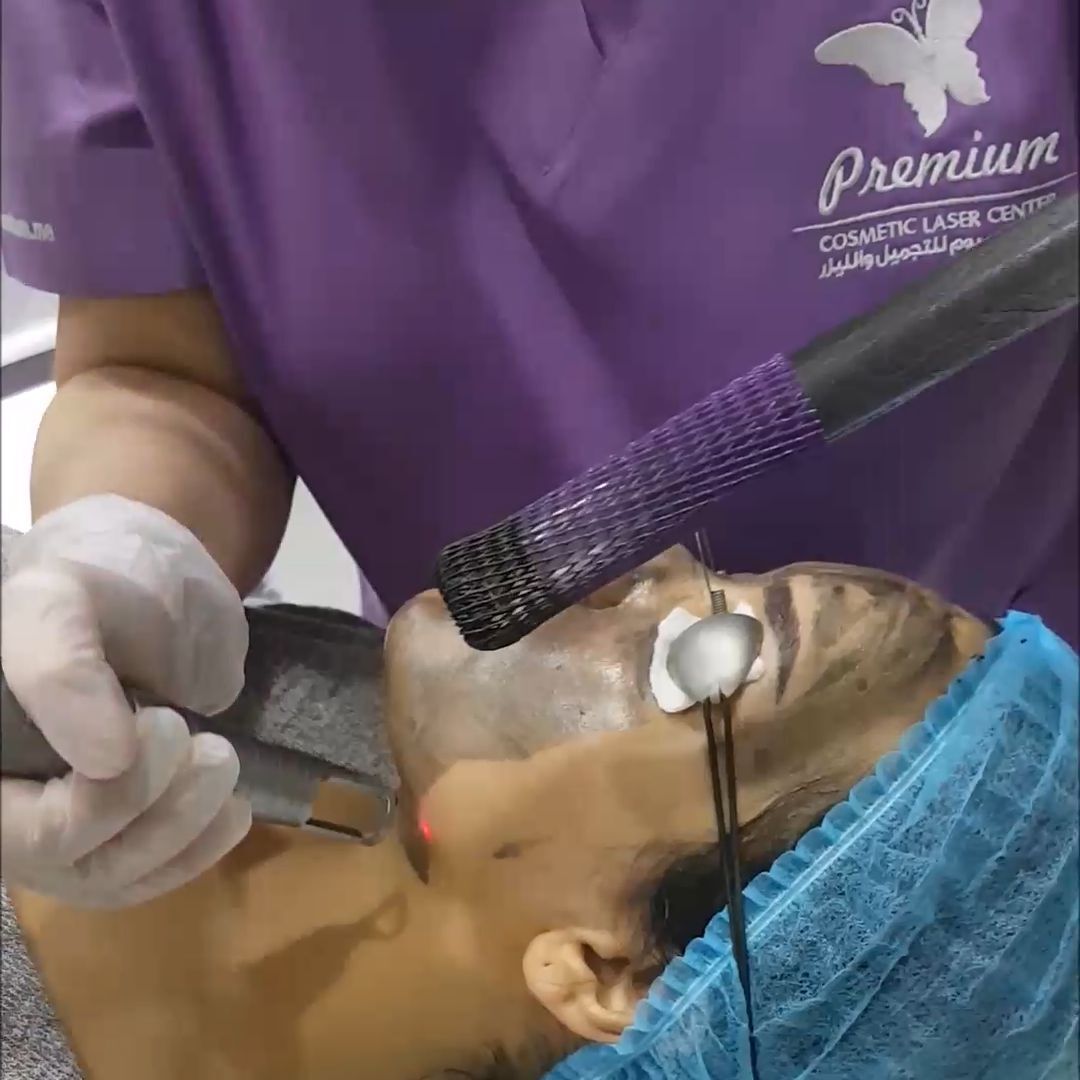 Laser Hollywood Peel